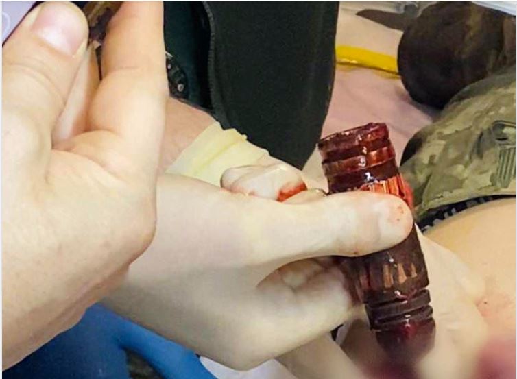 З тіла пораненого бійця ЗСУ військові хірурги дістали гранату (ФОТО)