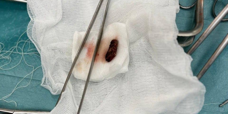 У Миколаєві прооперували захисника «Азовсталі» – лікарі дістали кулю з селезінки, яка «просиділа» там більше року (ФОТО)