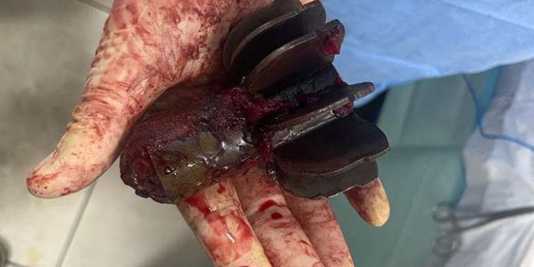 Військові лікарі в прифронтовому шпиталі видалили хвостовик міни з тіла пораненого захисника (ФОТО)