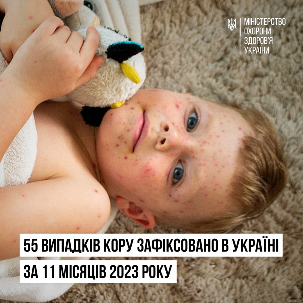 З початку року в Україні зареєстровано 55 випадків кору, більшість захворілих - діти 1