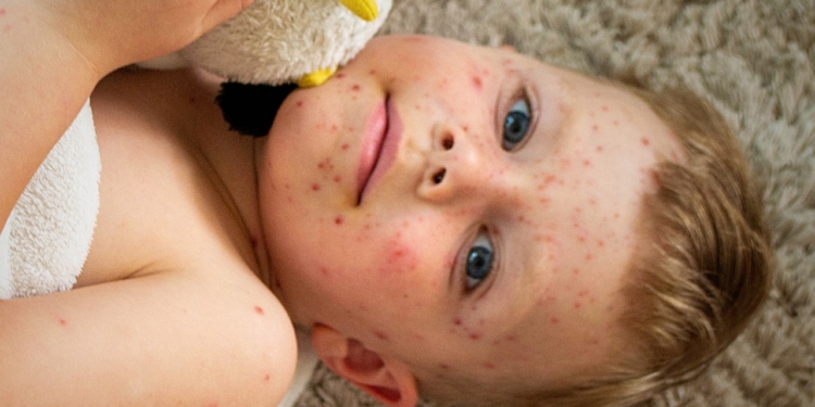 З початку року в Україні зареєстровано 55 випадків кору, більшість захворілих – діти
