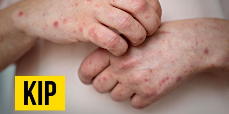 У 2023 році на кір в Україні захворіло ушестеро більше людей, ніж у 2022 році. В січні цього року вже зафіксовано 5 випадків