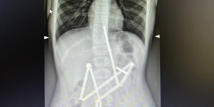 Лікарі Охматдиту врятували дитину, яка проковтнула 20 магнітів (ФОТО)