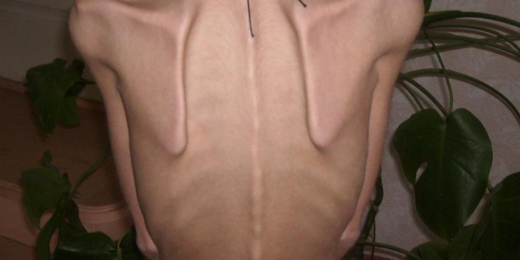 В Латвії стрімко зростає кількість дітей та підлітків, які хворіють на анорексію