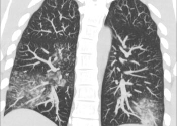 У Китаї – спалах метапневмовірусу. Голубовська каже, що і в Україні вже є 13 випадків, і дає поради