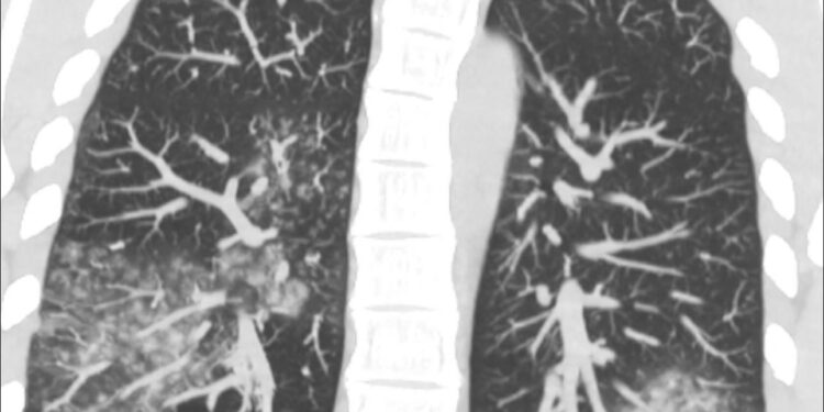 У Китаї – спалах метапневмовірусу. Голубовська каже, що і в Україні вже є 13 випадків, і дає поради