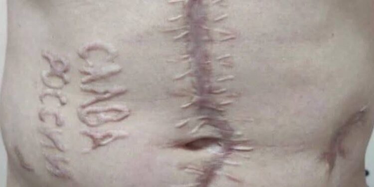 Рашисти випалили на тілі полоненого українці “слава росії” (ФОТО)