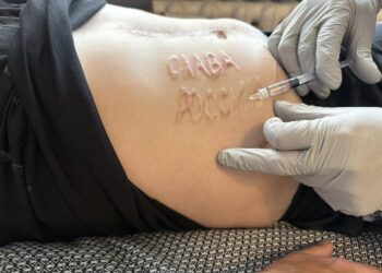 Шрамований напис “слава россии” на тілі українського воїна в полоні вирізав російський хірург. Наші лікарі його видалять (ФОТО)