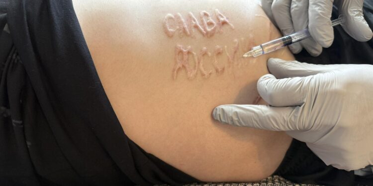 Шрамований напис “слава россии” на тілі українського воїна в полоні вирізав російський хірург. Наші лікарі його видалять (ФОТО)