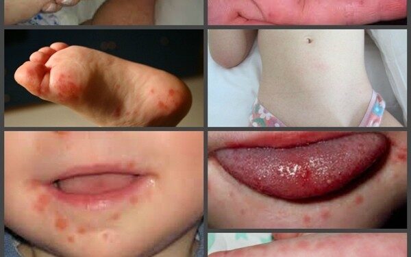 На Київщині зафіксовано спалах вірусу Коксакі – що це таке, і як убезпечитись