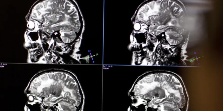 Швейцарські вчені знайшли новий підхід до лікування симптомів шизофренії