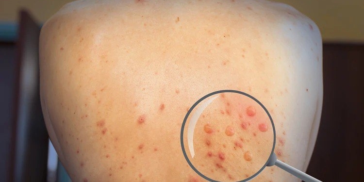 У Москві вже другий підтверджений випадок мавпячої віспи