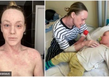 Загадкова хвороба шкіри спантеличує лікарів. Пацієнти кажуть одне – “і ворогу не побажаєш” (ФОТО)