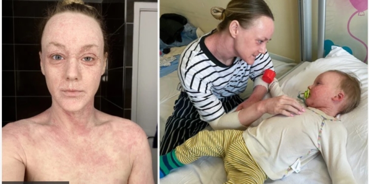 Загадкова хвороба шкіри спантеличує лікарів. Пацієнти кажуть одне – “і ворогу не побажаєш” (ФОТО)