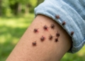 У Миколаєві до ЛШМД через укуси кліщів звернулося вже 3 людини
