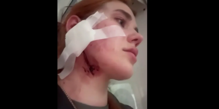 Українців знову побили в Польщі через акцент – у жінки розірване вухо та шия (ВІДЕО)